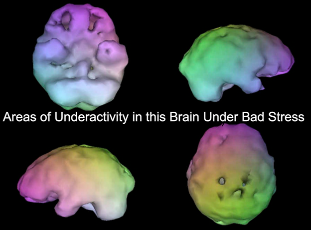 underactive brain scan